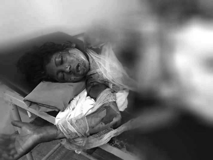 सिरहामा जिउँदै जलाएकी महिलाकाे काठमाडाैंमा उपचारकाे क्रममा मृत्यु